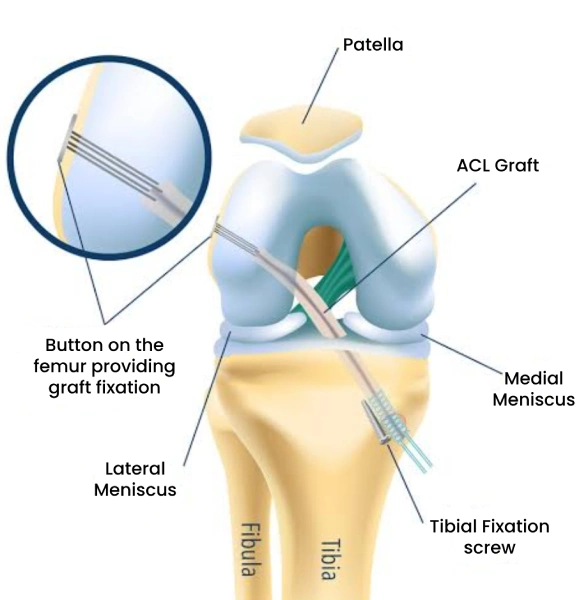 Anterior cruciate ligament (ACL) injuries