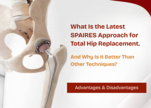 Latest SPAIRES Approach for Total Hip Replacement